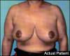 Breast Lift Patient