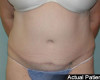 Tummy Tuck Patient