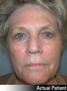 Eyelid Lift - Blepharoplasty Patient