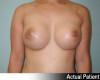 Breast Augmentation Patient