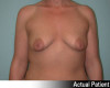 Breast Augmentation Patient