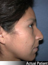 Nose Surgery Patient