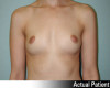 Breast Augmentation Patient