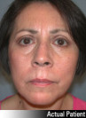 Eyelid Lift - Blepharoplasty Patient