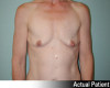 Breast Augmentation Patient