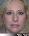 Brow Lift Patient