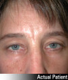 Eyelid Lift - Blepharoplasty Patient