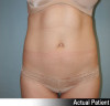 Liposuction Patient