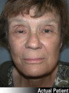 Facelift Patient