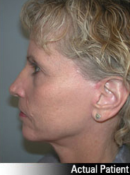 Patient # 25648 After Photo # 6