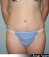 Tummy Tuck Patient