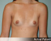 Breast Augmentation Patient