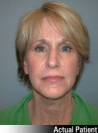 Facelift Patient