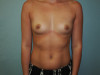 Breast Augmentation Patient