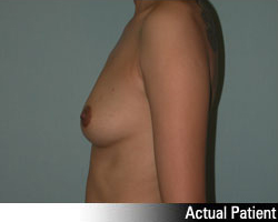 Patient # 16579 Before Photo # 5