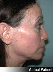 Patient # 18436 After Photo # 6