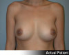 Breast Augmentation Patient