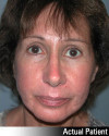 Brow Lift Patient