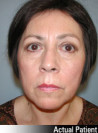 Facelift Patient