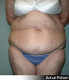 Tummy Tuck Patient