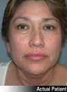 Facelift Patient