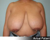 Breast Reduction Patient