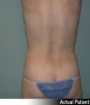 Liposuction Patient