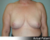 Breast Reduction Patient