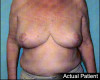 Breast Reduction Patient