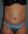 Tummy Tuck Patient