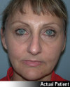 Eyelid Lift - Blepharoplasty Patient