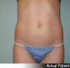 Liposuction Patient