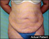 Tummy Tuck Patient