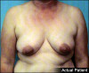 Breast Lift and Augmentation Patient