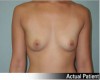 Breast Augmentation Patient