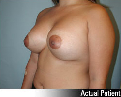 Patient # 26308 After Photo # 4