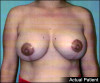 Breast Lift and Augmentation Patient