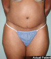 Tummy Tuck Patient