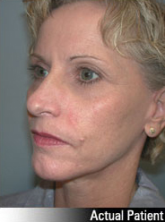 Patient # 25648 After Photo # 4