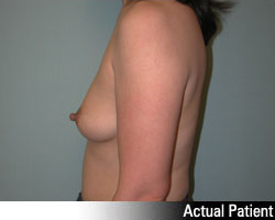 Patient # 90006 Before Photo # 5
