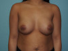 Breast Augmentation Patient