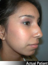 Nose Surgery Patient