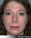 Eyelid Lift - Blepharoplasty Patient