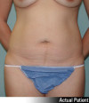 Tummy Tuck Patient