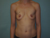 Breast Augmentation Patient