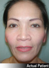 Eyelid Lift - Blepharoplasty Patient