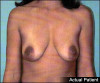 Breast Lift and Augmentation Patient