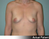 Breast Augmentation Patient