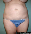 Tummy Tuck Patient