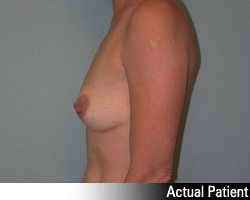 Patient # 83400 Before Photo # 5